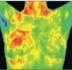 Breast Thermogram