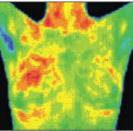 Breast Thermogram